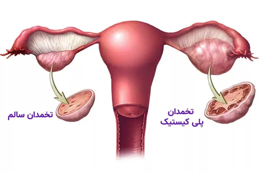 سندرم تخمدان پلی‌کیستیک (PCOS) یا تنبلی تخمدان؛ علائم، علل، تشخیص و درمان